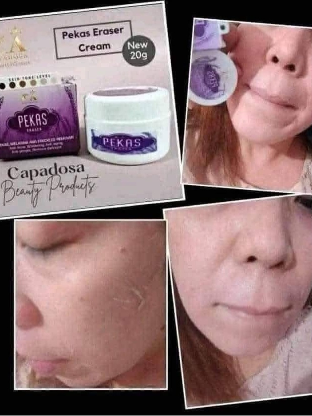 Melasma/pekas eraser for men and women